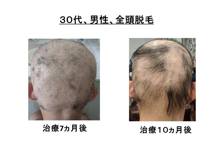 円形脱毛症　病院